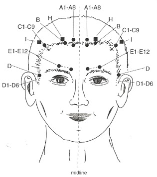 דיקור ראש יפני YNSA